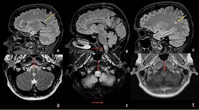 Case Report: Rapid Desensitization to Ocrelizumab for Multiple Sclerosis Is Effective and Safe